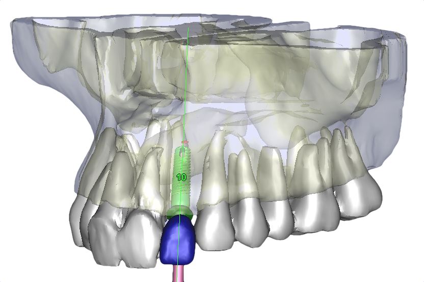 #10 Plan with Virtual Tooth
