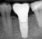 implant