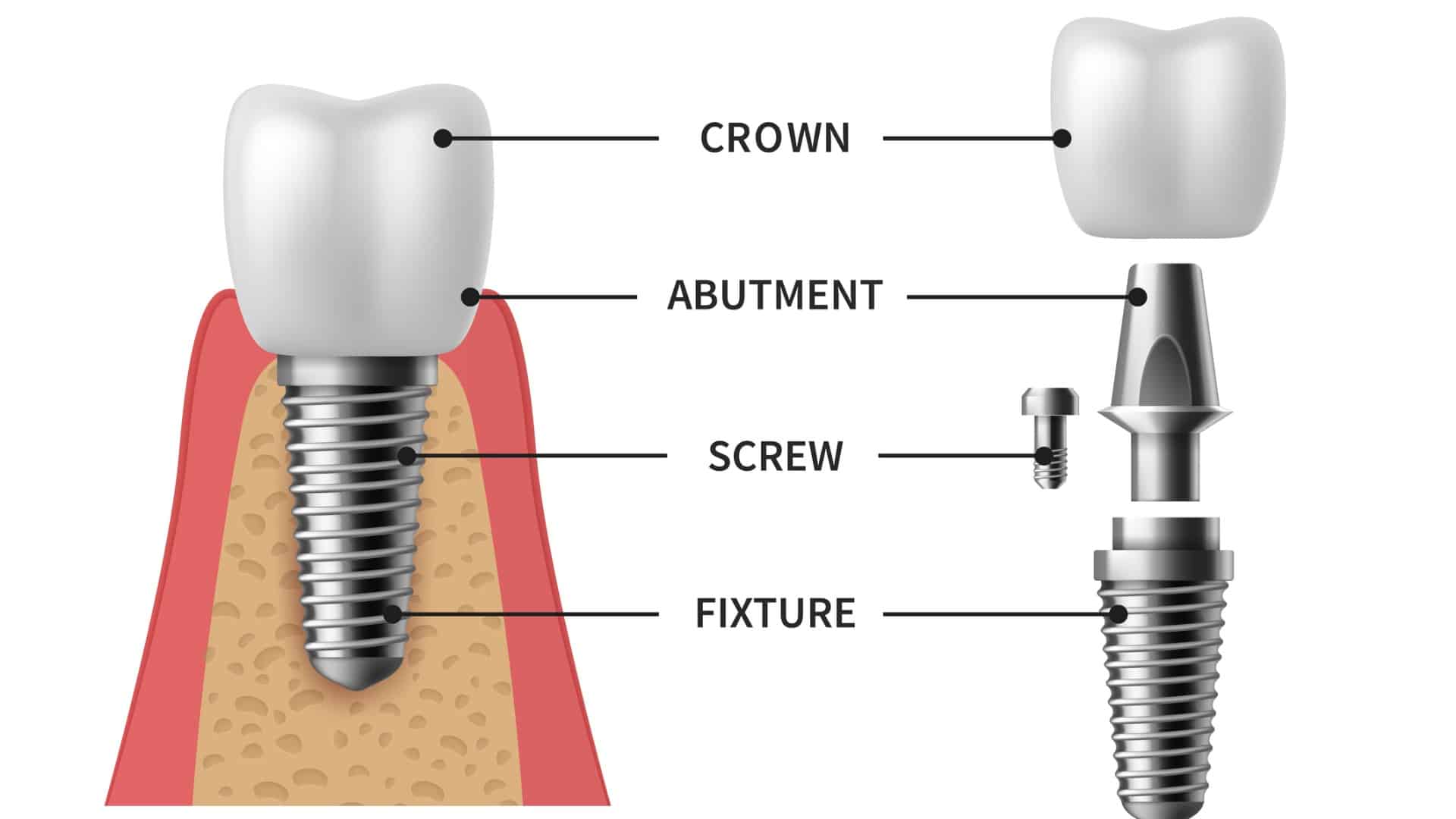 implant